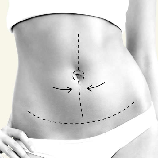 Abdominoplastia