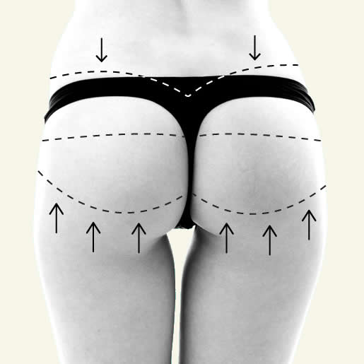 Gluteoplastia