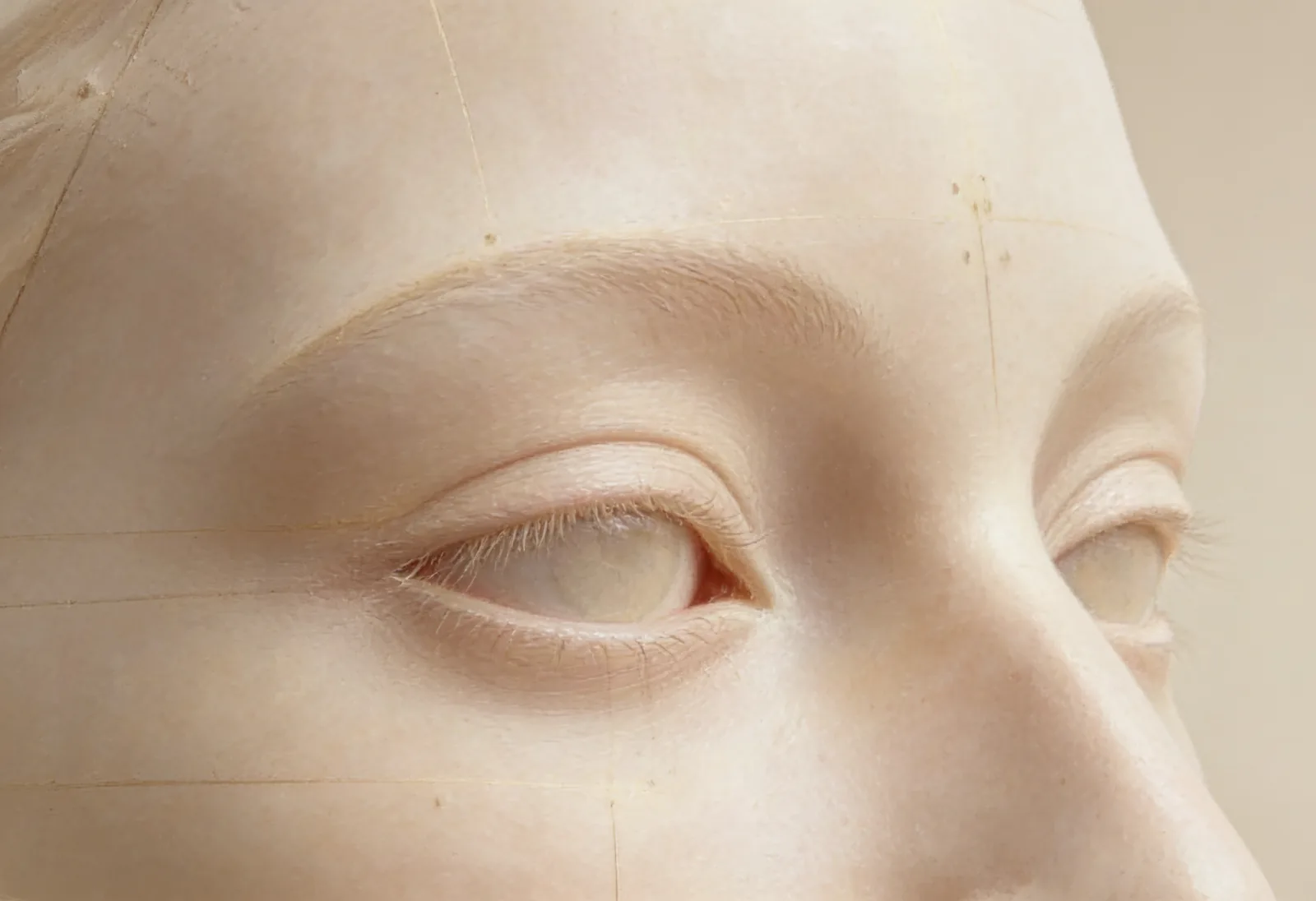 Blepharoplasty — Eyes